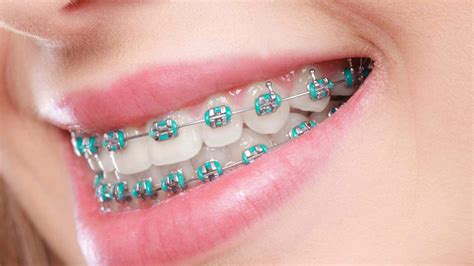 precio de brackets metalicos en mexico|precio de brackets en mexico.